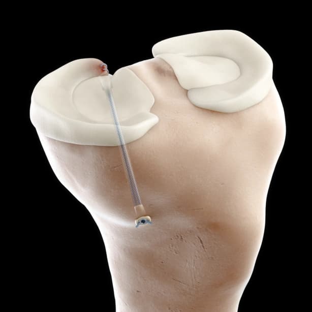 The One-Dimensional Problem: Beyond Interference Screw Fixation